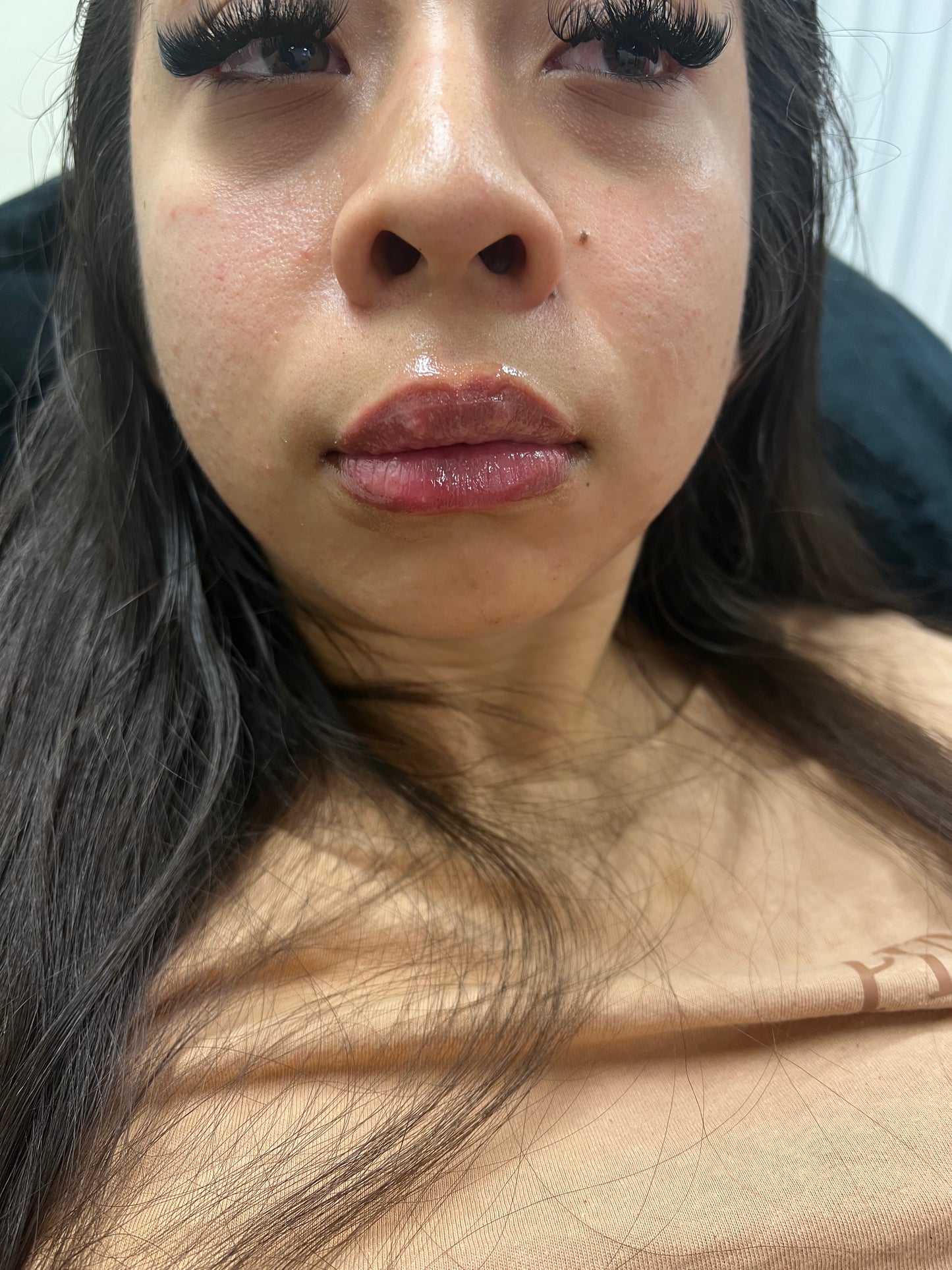 Juicy Lips - Lip Filler (Lip Enhancement)