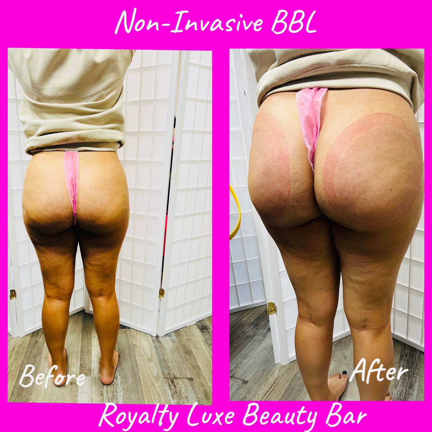 Apple Bottom Booty (Filler Enhancement)