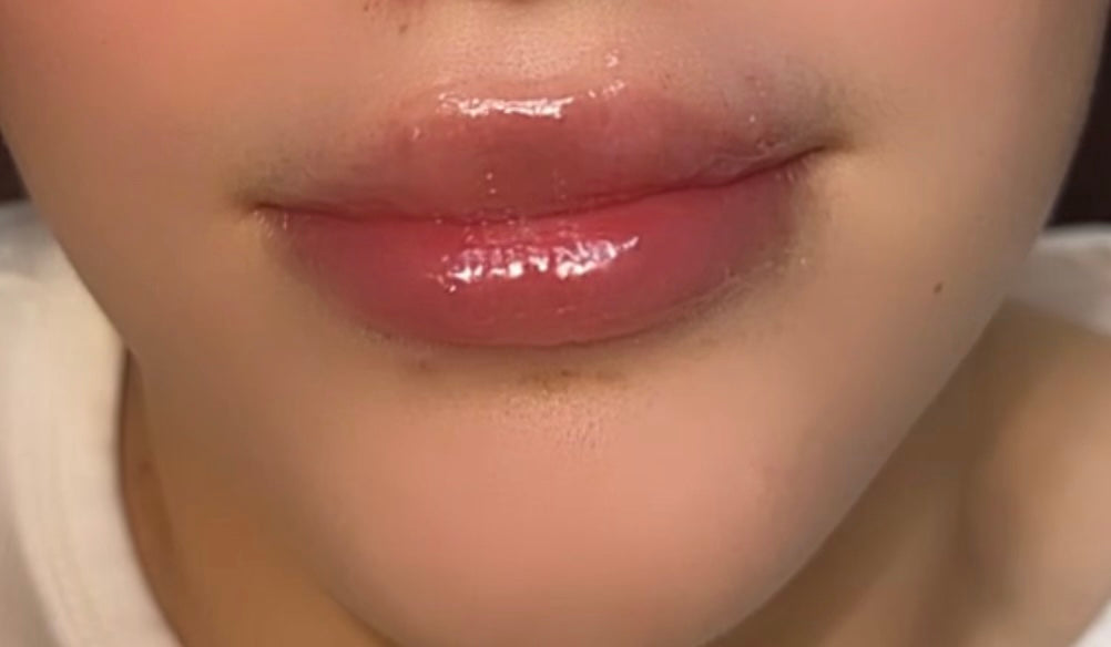 Juicy Lips - Lip Filler (Lip Enhancement)