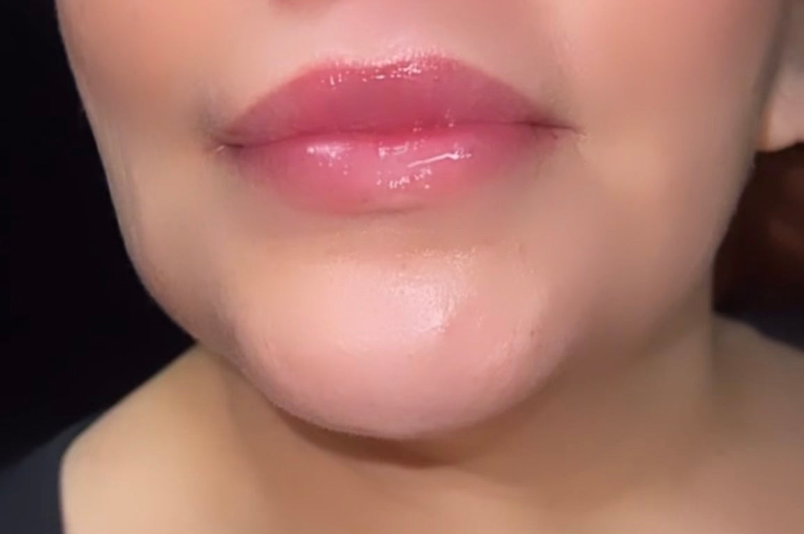 Juicy Lips - Lip Filler (Lip Enhancement)