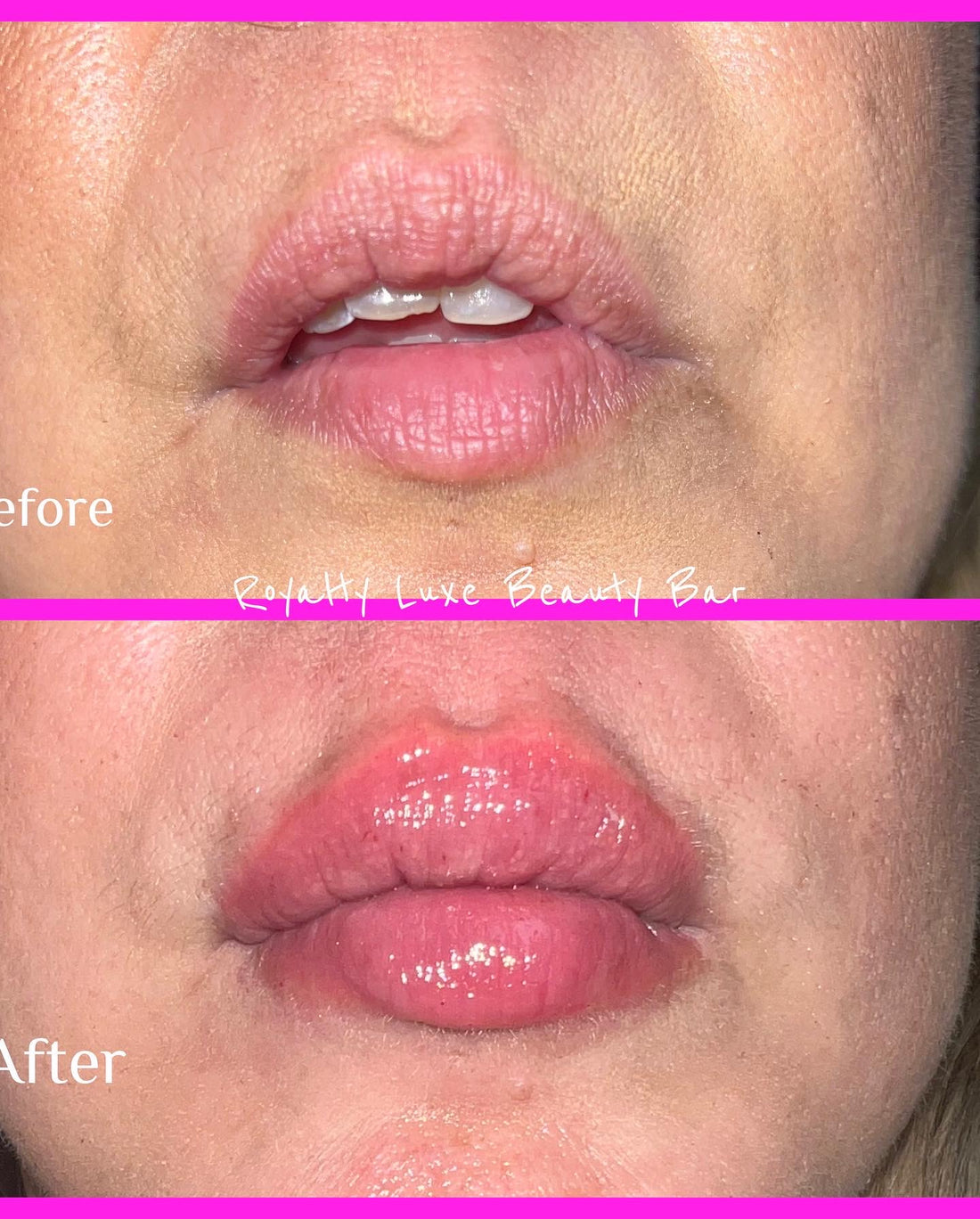 Juicy Lips Lip Filler (Lip Enhancement) Janique Janee Cosmetics