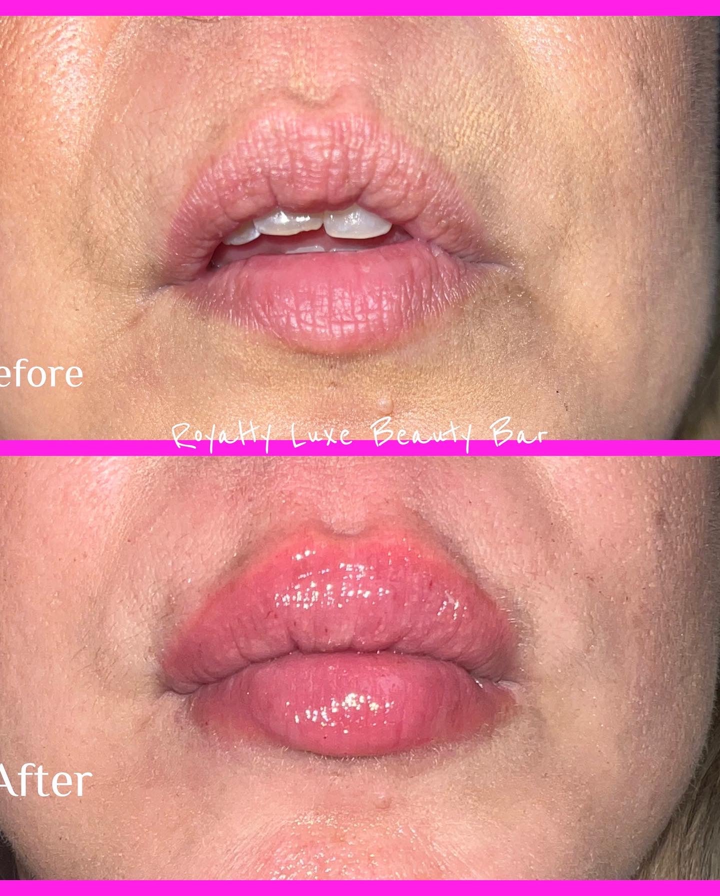 Juicy Lips - Lip Filler (Lip Enhancement)