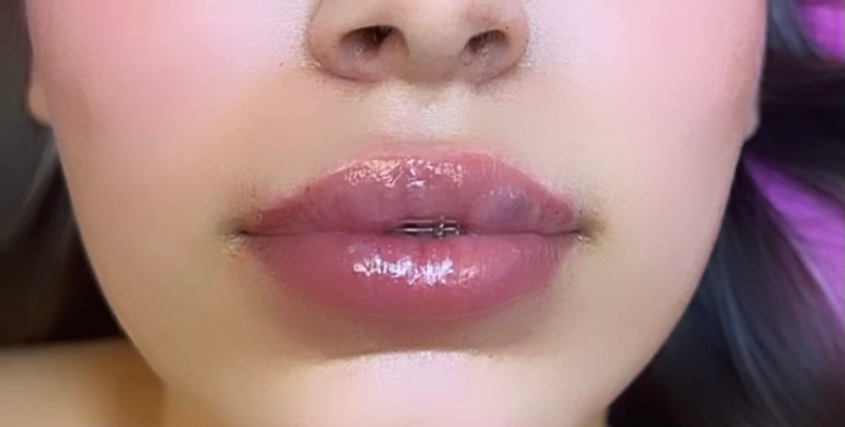 Juicy Lips - Lip Filler (Lip Enhancement)