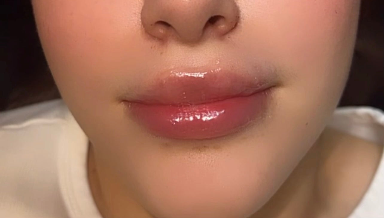 Juicy Lips - Lip Filler (Lip Enhancement)