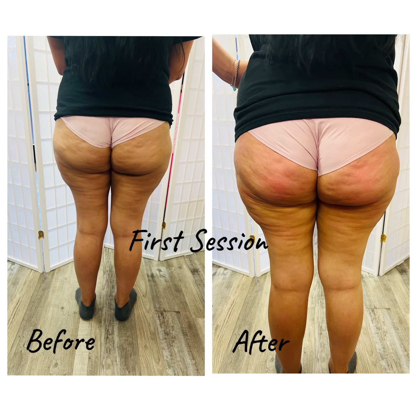 Apple Bottom Booty (Filler Enhancement)